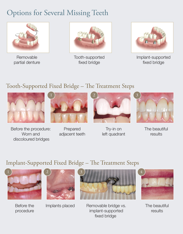 Why Dental Implants - Mississauga, Meadowvale, Streetsville, Milton, Georgetown, Brampton