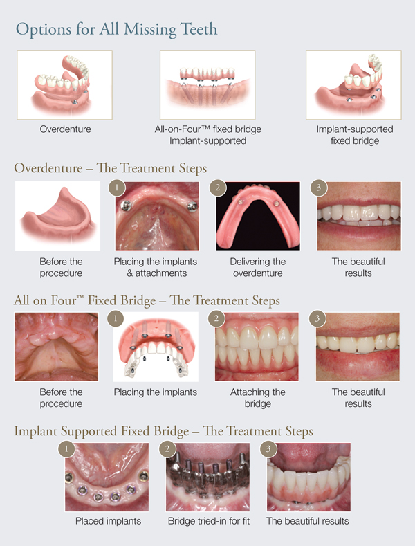 Why Dental Implants - Mississauga, Meadowvale, Streetsville, Milton, Georgetown, Brampton