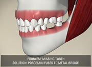 Implants - Mississauga, Meadowvale, Streetsville, Milton, Georgetown, Brampton